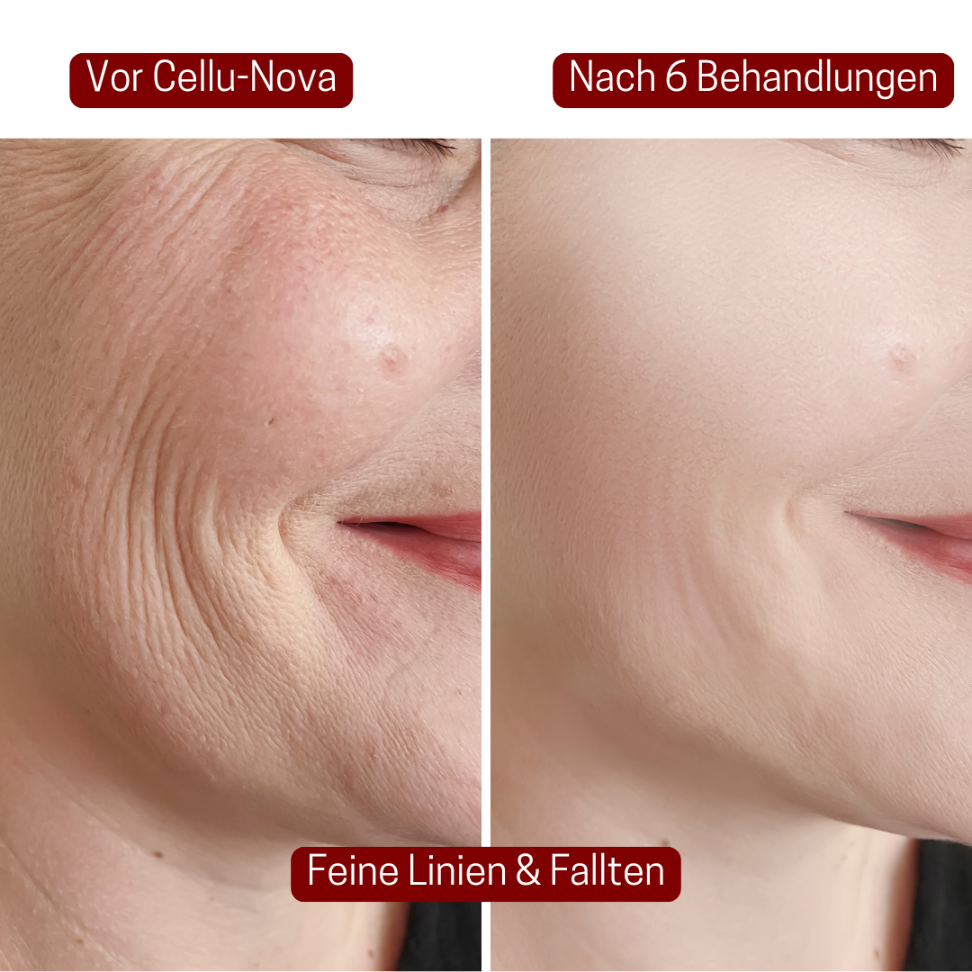 CelluNova Micro Infusion System™