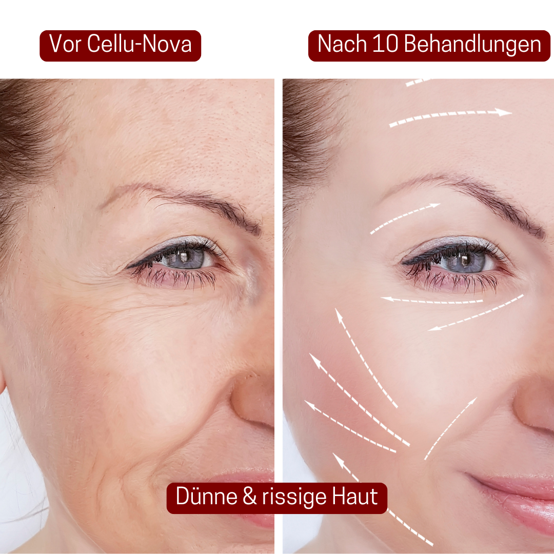 CelluNova Micro Infusion System™