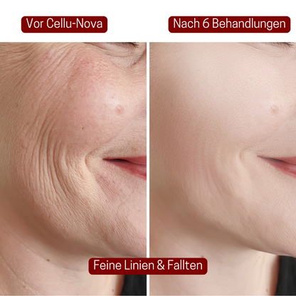 CelluNova Micro Infusion System™